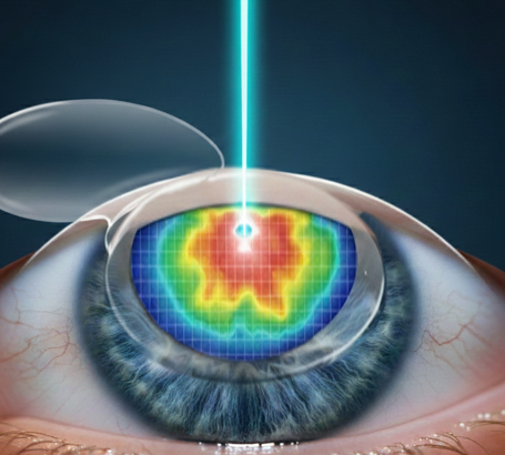 LASIK (Laser-Assisted In Situ Keratomileusis):