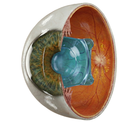Reversible: the lens can be removed or exchanged if needed.