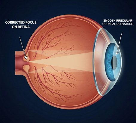 smooths irregular corneal curvature for clearer vision.
