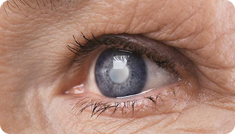 Cataract