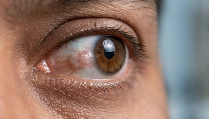 Conjunctival Tumor