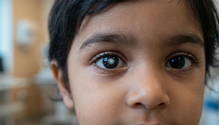 Retinoblastoma